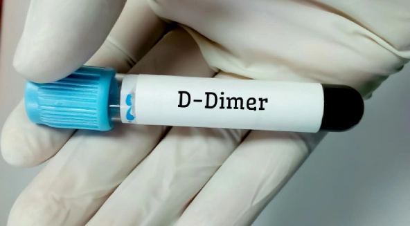 D dimer nədir - D dimer analizi qiyməti - D dimer testi